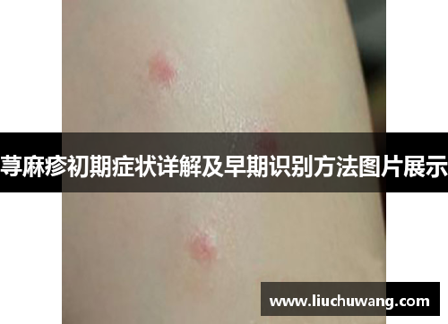 荨麻疹初期症状详解及早期识别方法图片展示